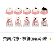 虫歯・根管(神経)治療