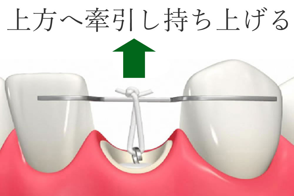 エクストルージョン（歯根挺出術）