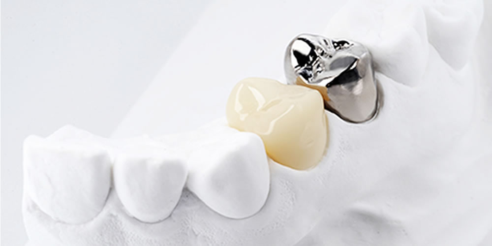 保険適用の白い歯(CAD/CAM冠)による治療