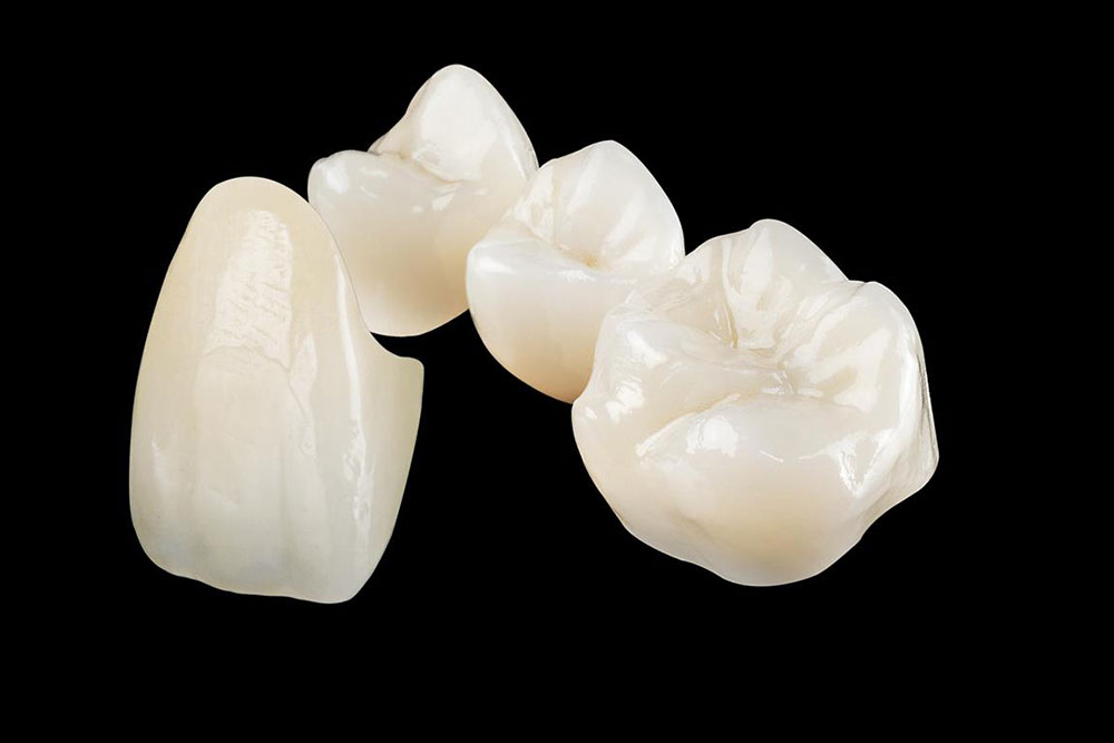 精密なかぶせ物の作製