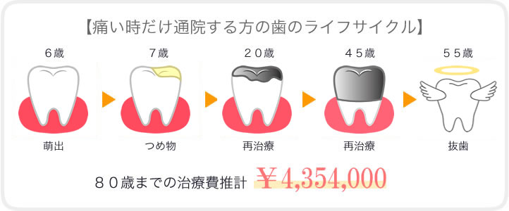 予防に取り組む人と痛い時にだけ治療する人の歯の寿命・治療費の比較