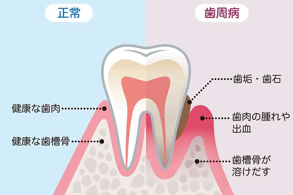 日本成人の約80%がかかっている歯周病の症状と原因