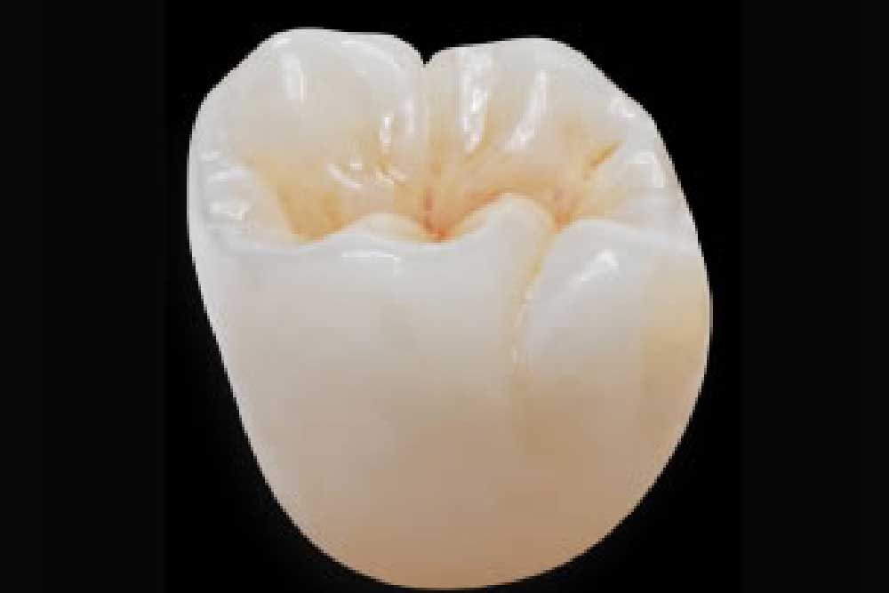 オールセラミック(レイアリング)