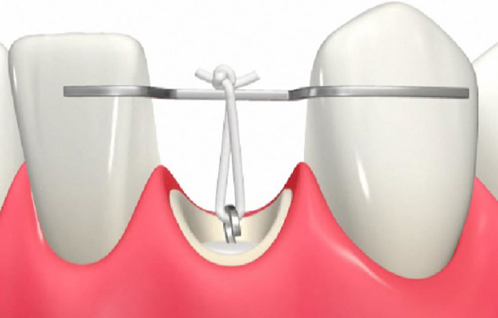 エクストリュージョン